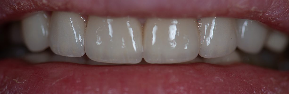 dantų cirkonio keramika – Restauracinė odontologijos klinika
